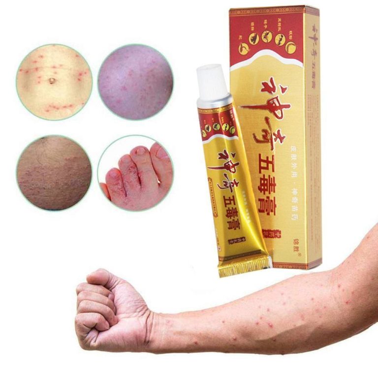 Chinese Herbal Psoriasis Relief Cream - Casta Trends Shop